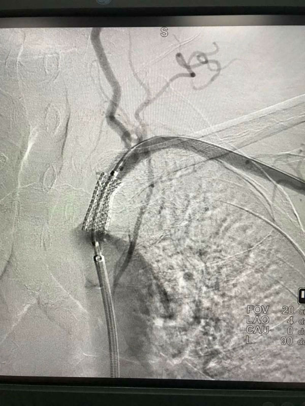 市四院成功开展左锁骨下动脉高度狭窄支架植入术